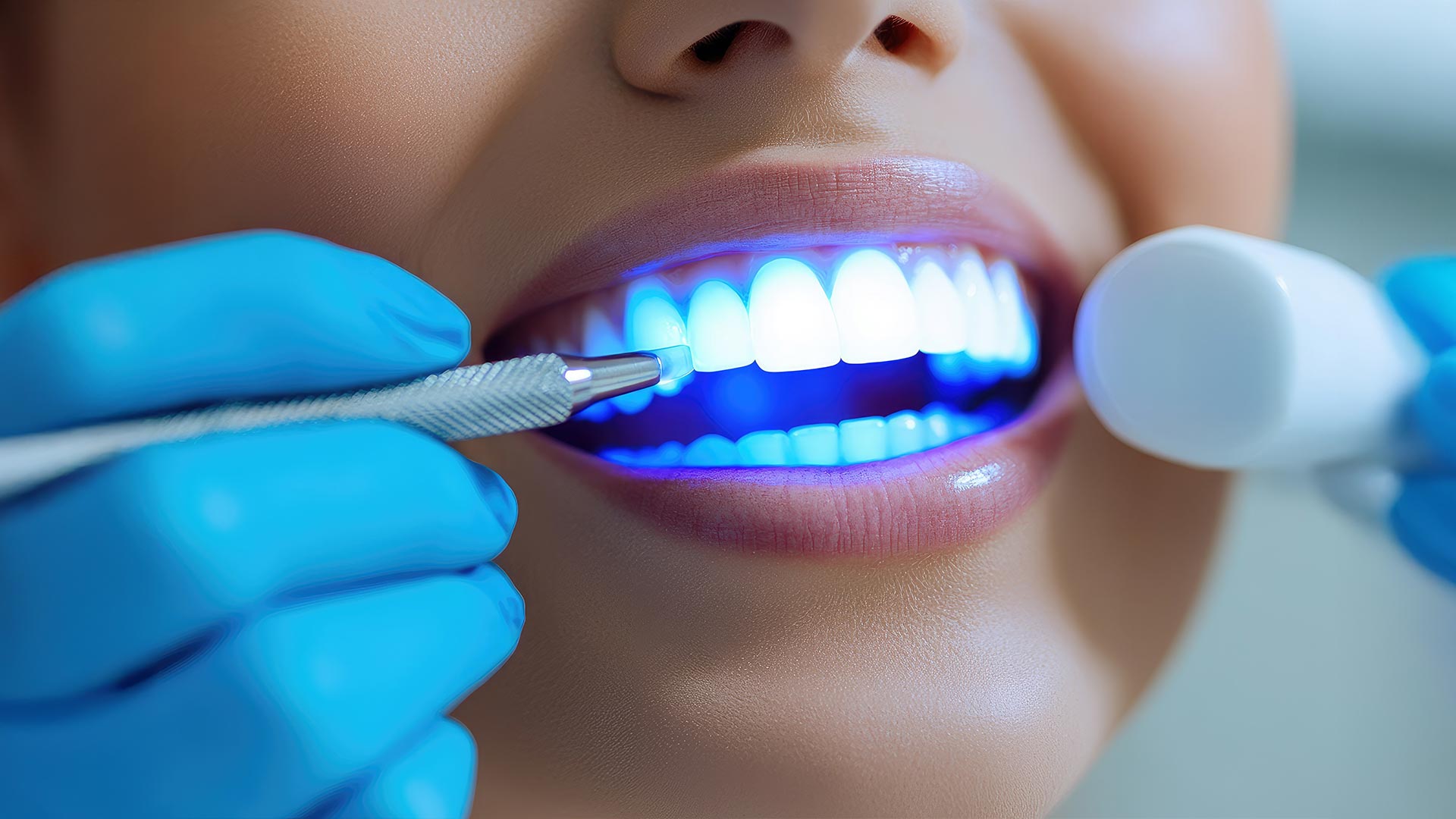 Immagine Sbiancamento | MFL | Studio Dentistico Odontoiatrico a Fossalta di Piave VE